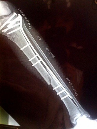 Ameliyat sonrası bacağım